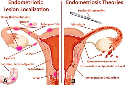 Immunological Basis of the Endometriosis: The Complement System as a Potential Therapeutic Target